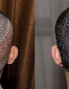 Türkei etabliert sich als führendes Ziel für Haartransplantationen (Foto: AdobeStock - Sugrit - 290465761)
